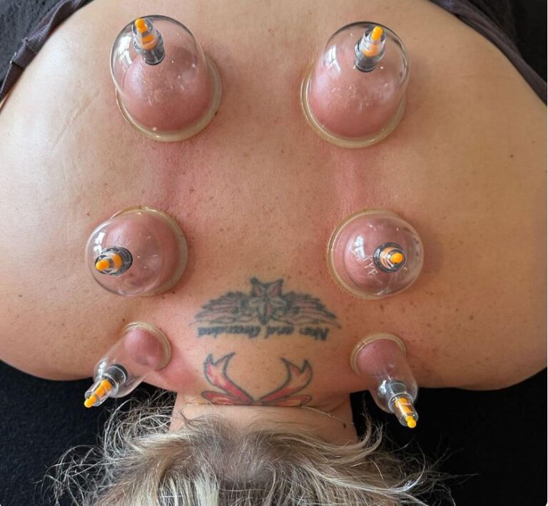 cupping therapy 768x709